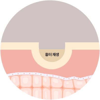 심한 여드름 흉터