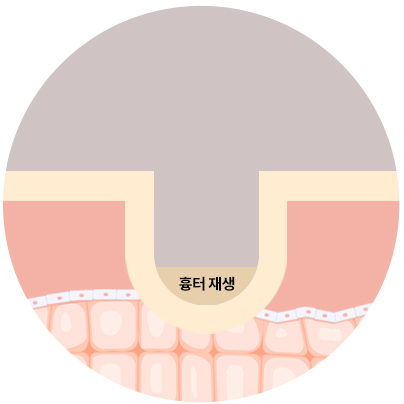 심한 여드름 흉터