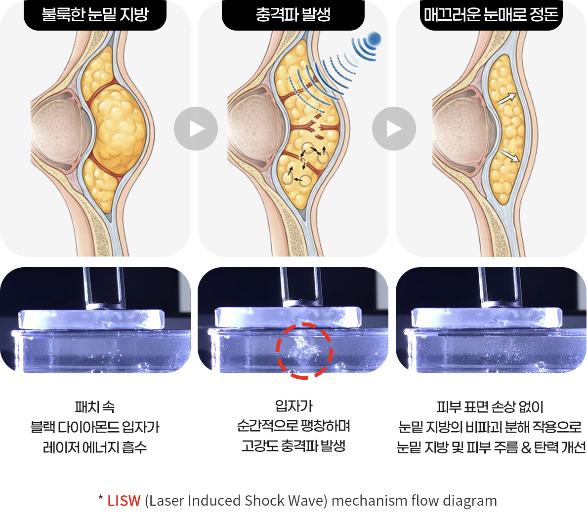 런치타임 눈밑 레이저